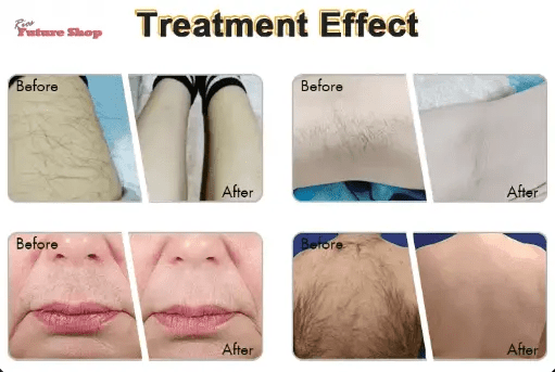 ADSS-Aparelho-remocao-Pelos-ADSS-99756483 - Rios Future Shop
