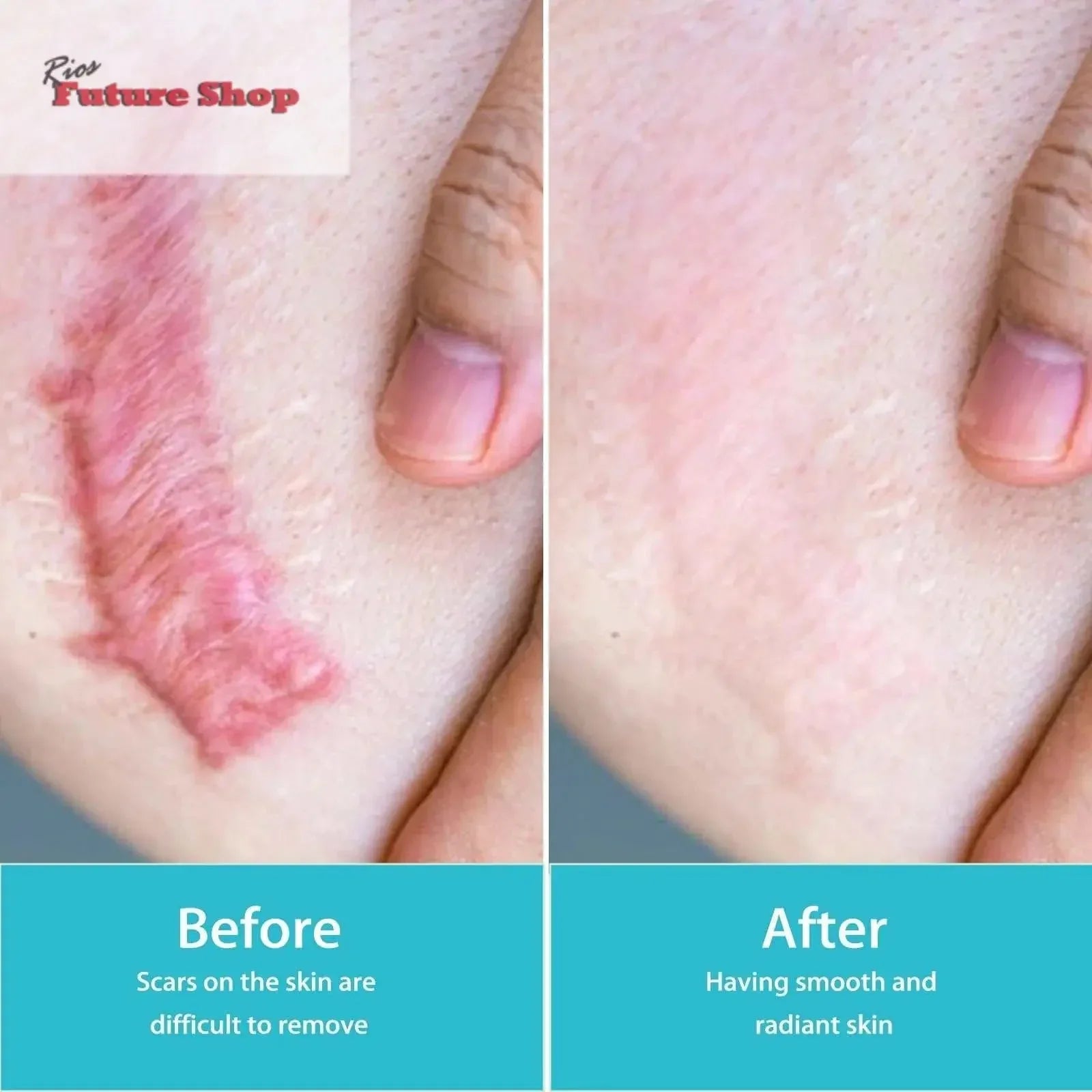 Spray Clareador de Cicatrizes para Pele Corporal - Rios Future Shop